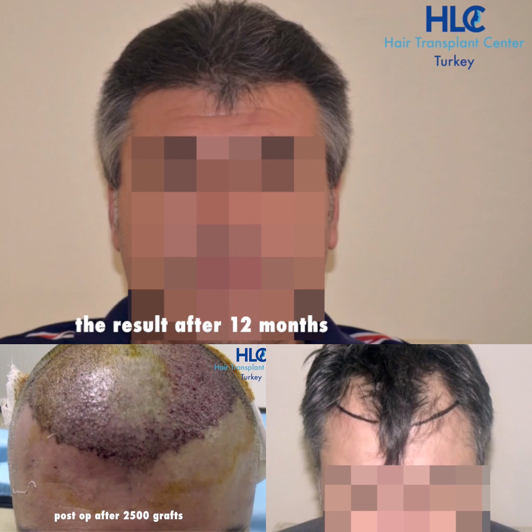 Beispiel 1 - Haartransplantation Geheimratsecken Vorher Nachher Hairforlife.at