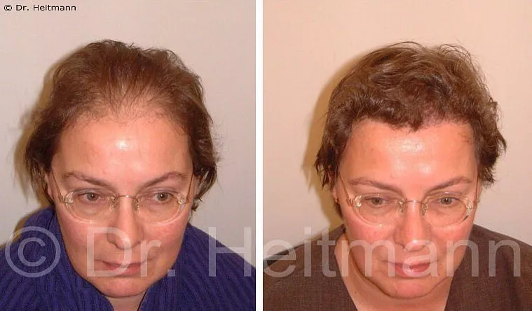 Beispiel 1 Haartransplantation Frauen Vorher Nachher Hairforlife.at