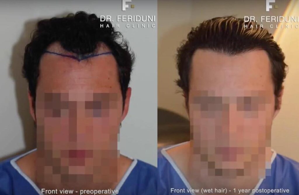 Beispiel 2 - Haartransplantation Geheimratsecken Vorher Nachher Hairforlife.at