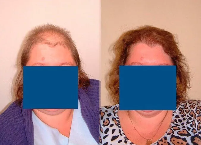 Beispiel 2 Haartransplantation Frauen Vorher Nachher Hairforlife.at