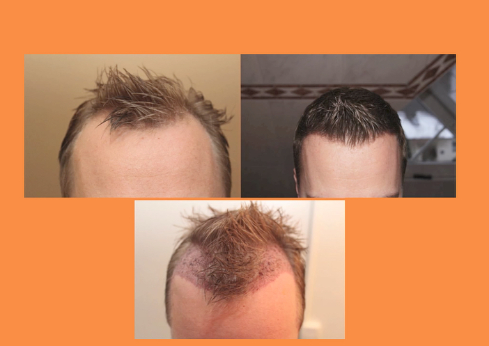 Beispiel 3 - Haartransplantation Geheimratsecken Vorher Nachher Hairforlife.at