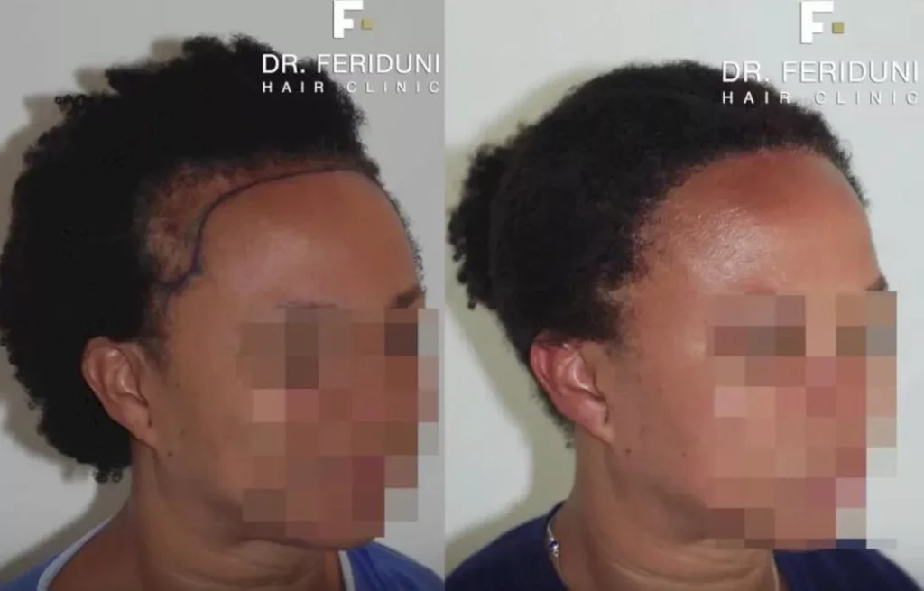 Beispiel 4 Haartransplantation Frauen Vorher Nachher Hairforlife.at