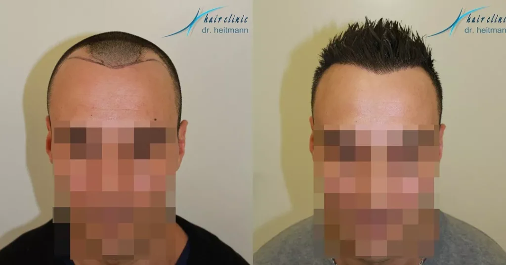 Beispiel 4 - Haartransplantation Geheimratsecken Vorher Nachher Hairforlife.at