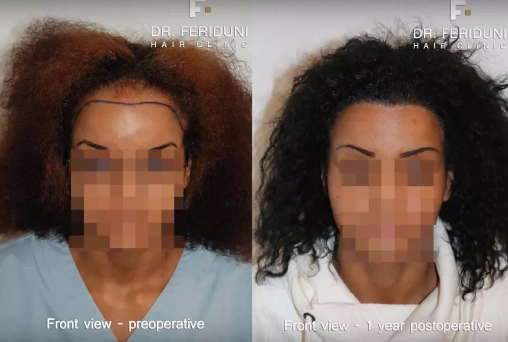Beispiel 3 Haartransplantation Frauen Vorher Nachher Hairforlife.at