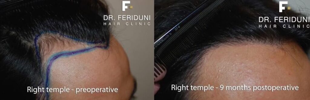 Haartransplantation Geheimratsecken Vorher Nachher Dr. Feriduni 1500 FUs Hairforlife.at