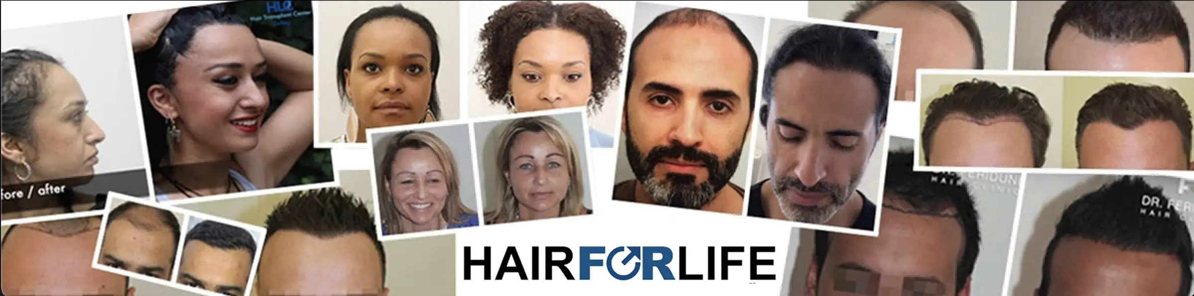 Haartransplantation Beratung Österreich Ärzte Kliniken Hairforlife.at