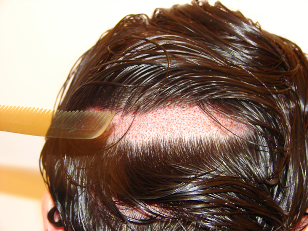 Haartransplantation Rasur Streifen Version Hairforlife.at
