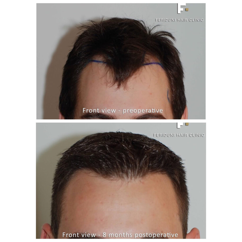 Haartransplantation Geheimratsecken Vorher Nachher Hairforlife.at 2400 FUs Dr. Heitmann