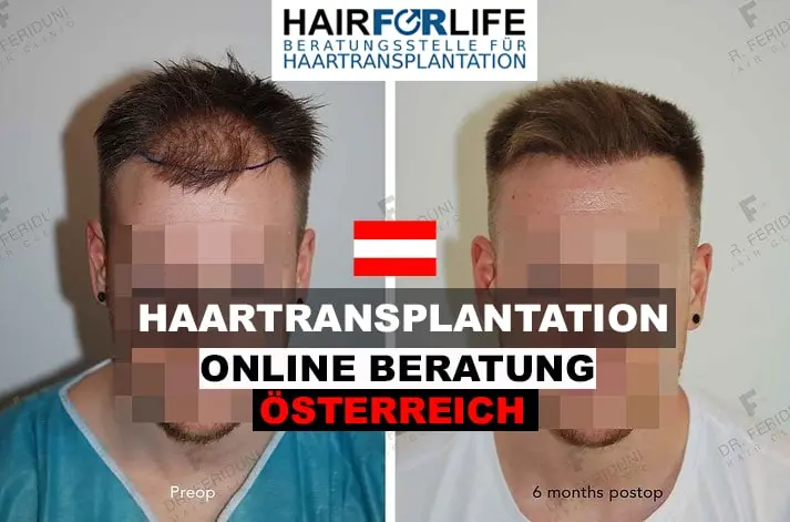 Haartransplantation Beratung Österreich von Hairforlife.at Ärzte und Kliniken