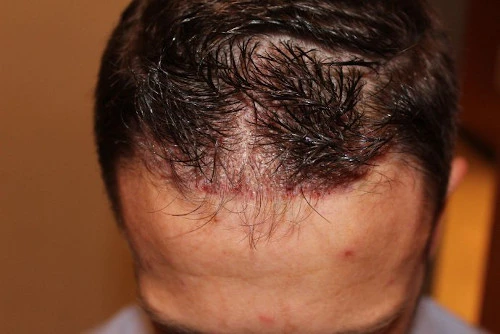 Haartransplantation ohne Rasur rasieren Hairforlife Österreich