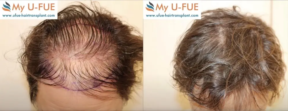 Ratgeber Hairforlife.at Haartransplantation ohne Rasur Vorher Nachher Ratgeber Hairforlife.at Haartransplantation ohne Rasur Vorher Nachher