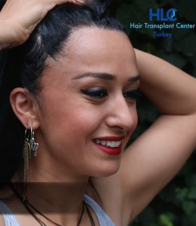 Haartransplantation Frauen Hairforlife Österreich